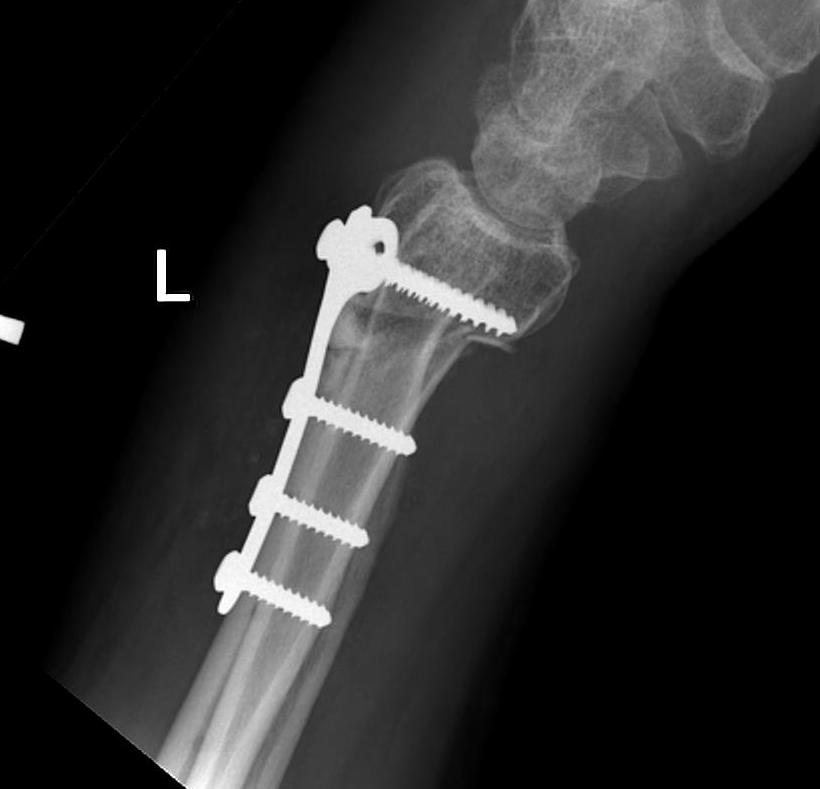 Distal Radial Malunion Dorsal Osteotomy